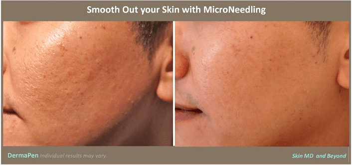 Aesthetic Solutions, Inc. | Medical Micro Needling FAQs