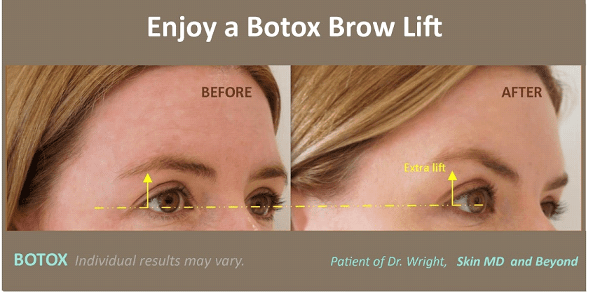 eyebrow droop brow botox lift thermismooth eyebrows drooping tx complications frisco plano treatment rejuvenation skinmdandbeyond