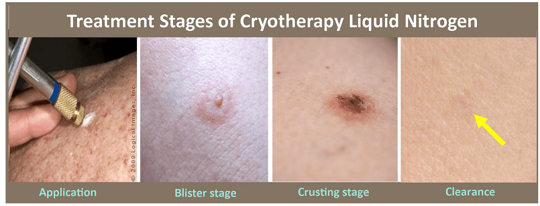 Cryosurgery Liquid Nitrogen In Plano Tx Skin Md And Beyond