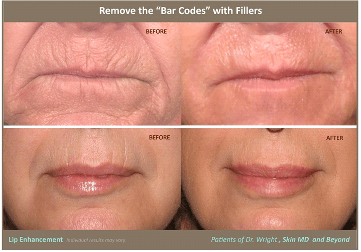 lip-lines-borders-cosmetic-skin-care-specialist-plano-tx