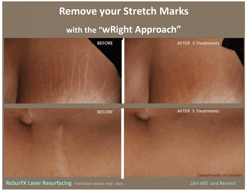 How to Get Rid of Stretch Marks Fast | Top 10 Home Remedies