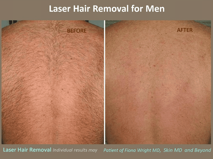 Male Laser Hair Removal Plano Tx Skin Md And Beyond 4593