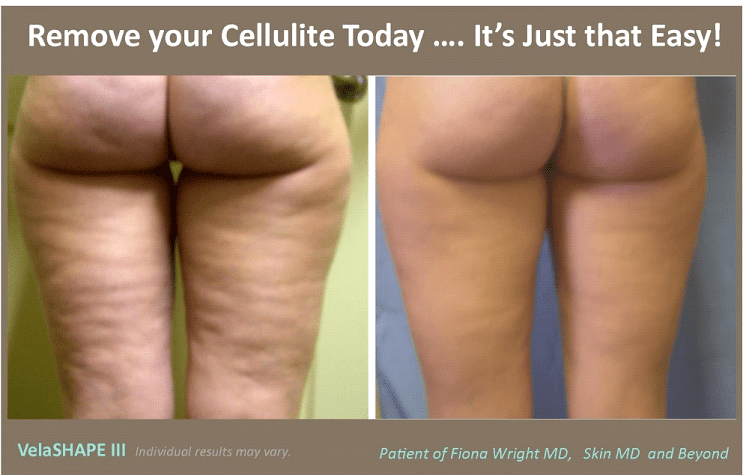 Velashape, Smooth, Tone & Reduce Cellulite