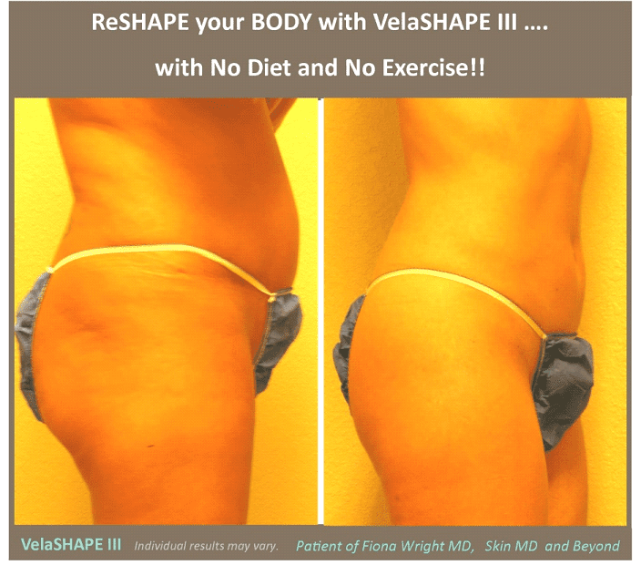 VelaSHAPE Plano TX  Body Contouring Frisco TX