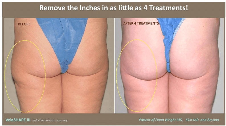 Hacks for Getting Rid of Cellulite: Smooth Body Contours: Aesthetic Medical  Spa