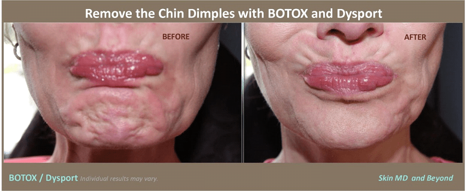 Chin Contouring Plano TX Jaw Contouring Frisco Double Chin