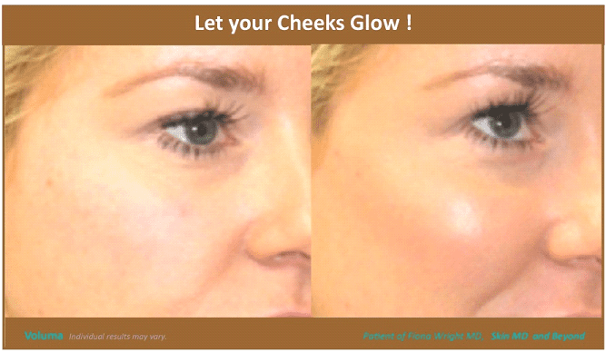 CHEEK REJUVENATION