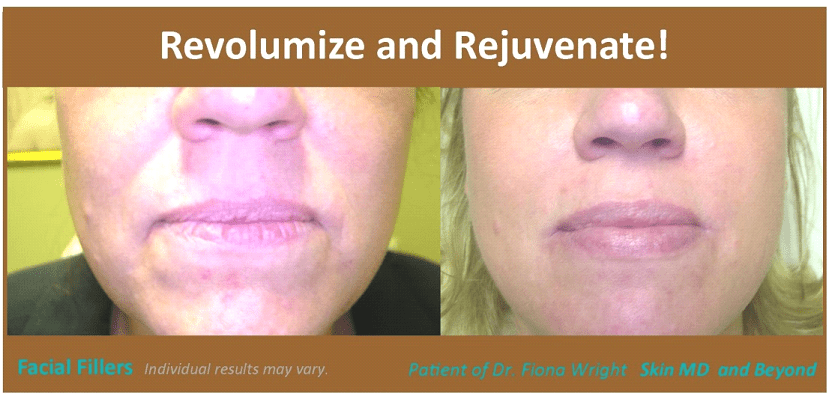 CHEEK REJUVENATION