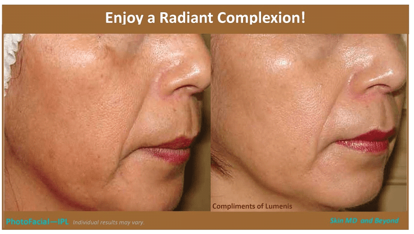 CHEEK REJUVENATION