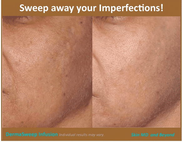 CHEEK REJUVENATION