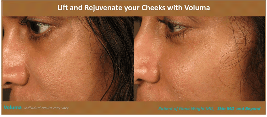 CHEEK REJUVENATION