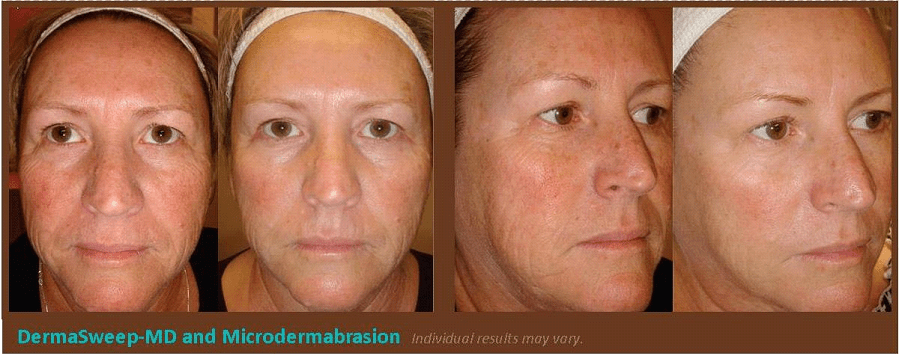 CHEEK REJUVENATION