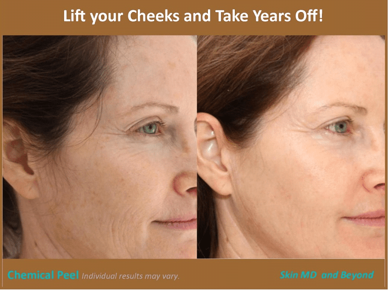 CHEEK REJUVENATION