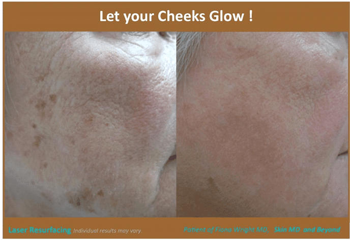 CHEEK REJUVENATION