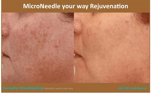 CHEEK REJUVENATION