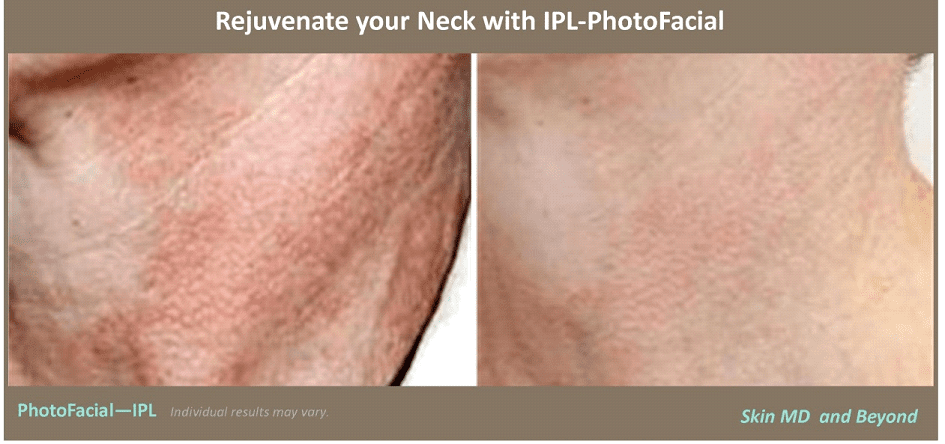 Neck Rejuvenation Plano TX | Skin Tightening Frisco TX 