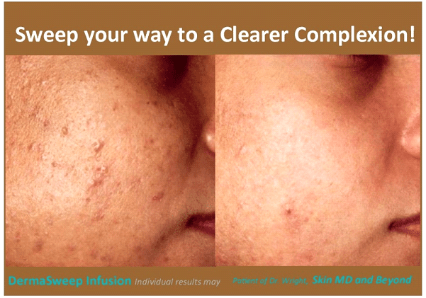 clear complexion plano tx