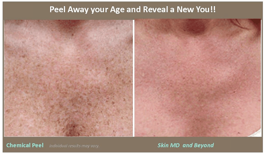 Cheek Rejuvenation Plano TX