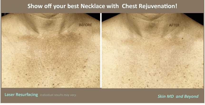 Chest and Decollate Rejuvenation