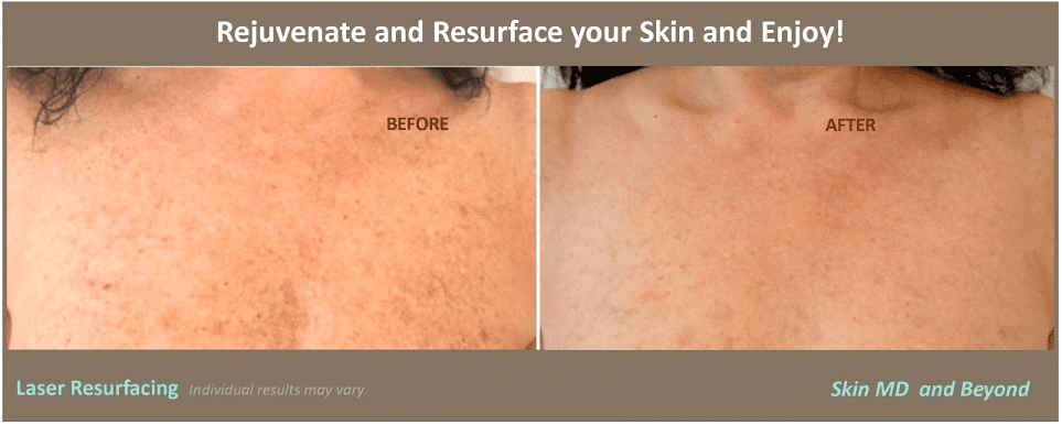Chest and Decollate Rejuvenation