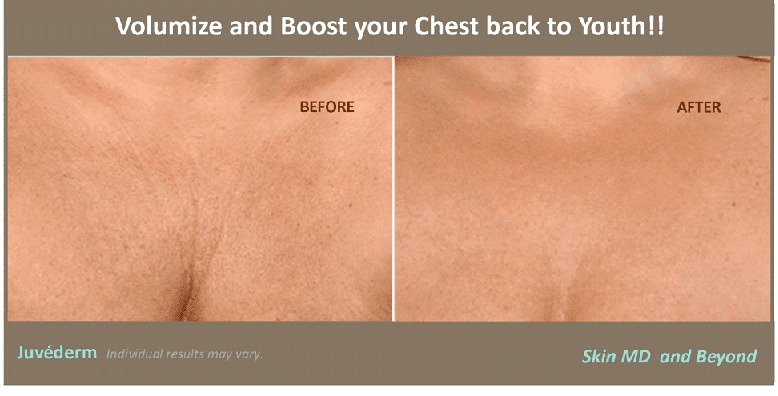 Chest and Decollate Rejuvenation