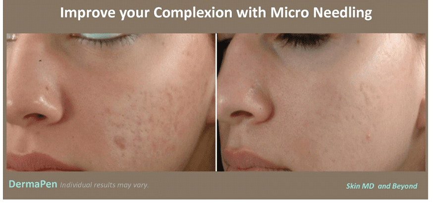 DERMAPEN – MICRONEEDLING