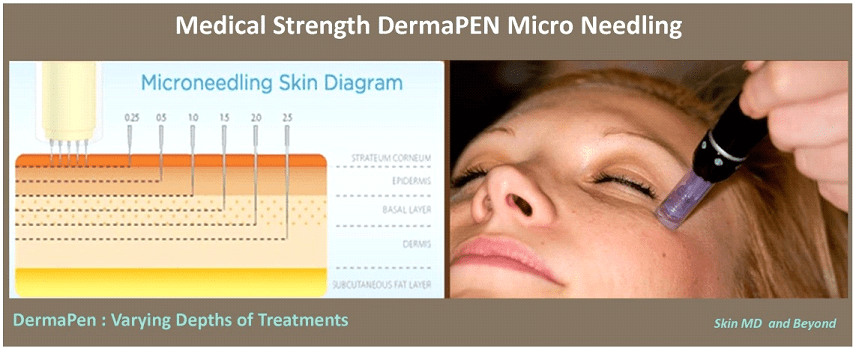 DERMAPEN – MICRONEEDLING