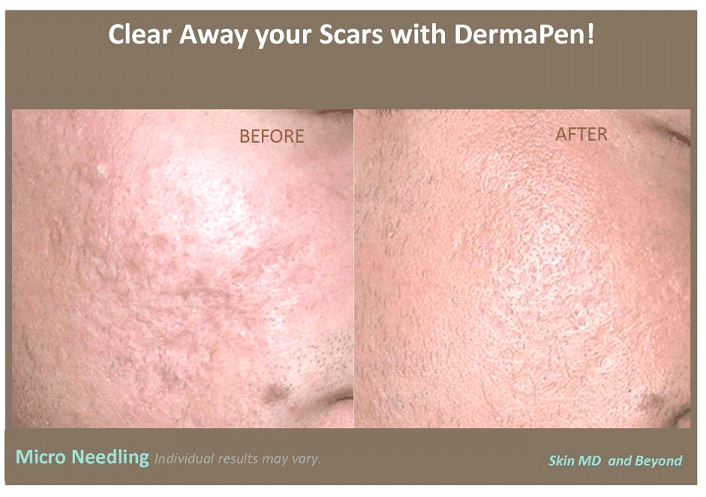 DERMAPEN – MICRONEEDLING