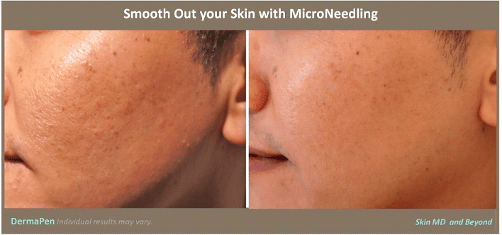 DERMAPEN – MICRONEEDLING