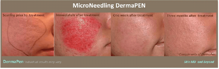 DERMAPEN – MICRONEEDLING