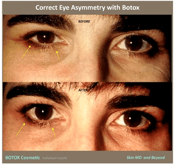 EYE ASSYMETRY