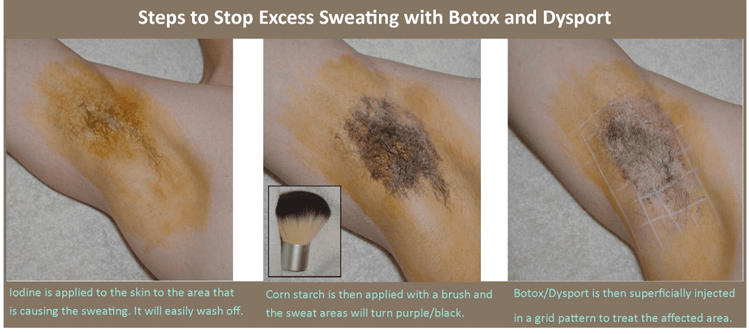 Excessive Sweating