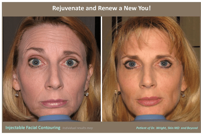 FACIAL CONTOURING