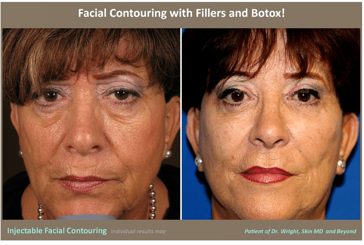 Non-Surgical Jawline Contouring - An Alternative to Facial Implants