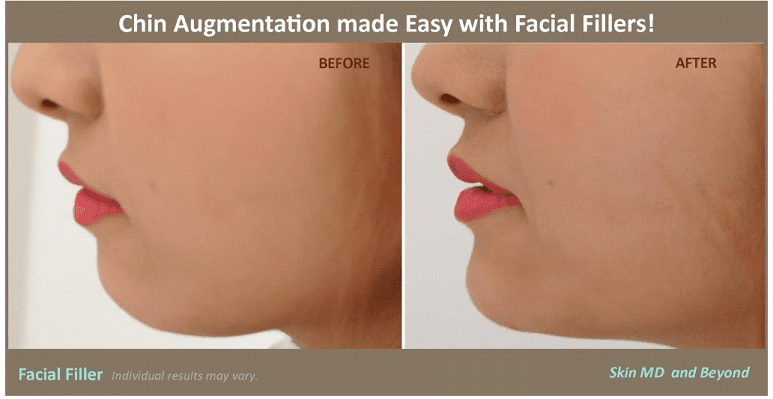 Non-Surgical Jawline Contouring - An Alternative to Facial Implants