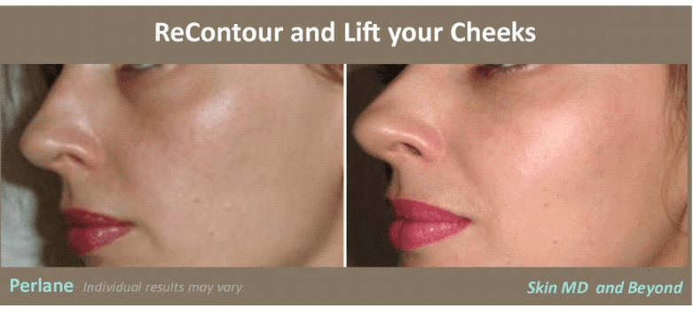 contour cheeks with filler