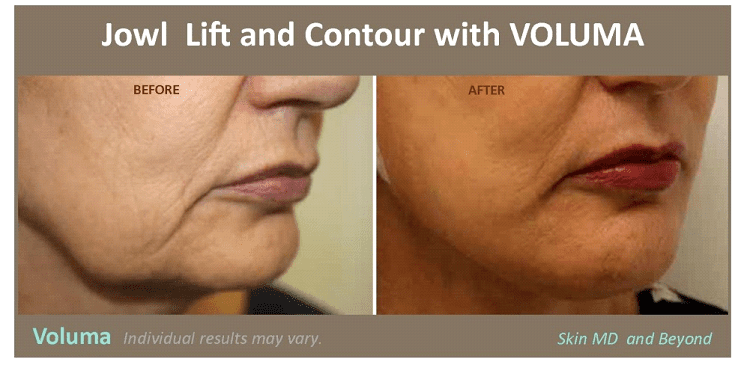 Facial Skin Laxity Treatment Plano, TX | Skin MD & Beyond