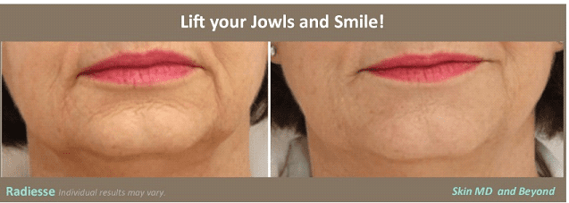 before and after photo of woman's mouth after skin laxity treatment