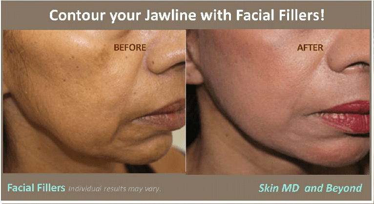 Facial Fillers