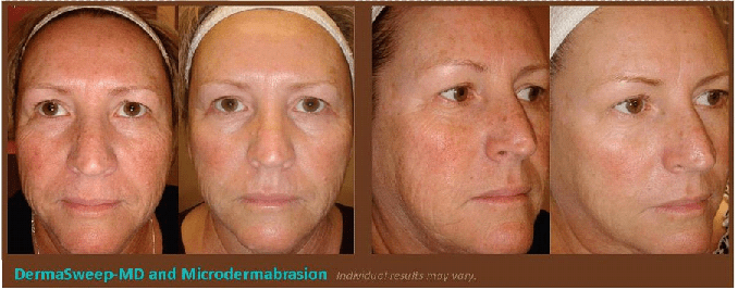 Facial Lines – Fine lines and wrinkles