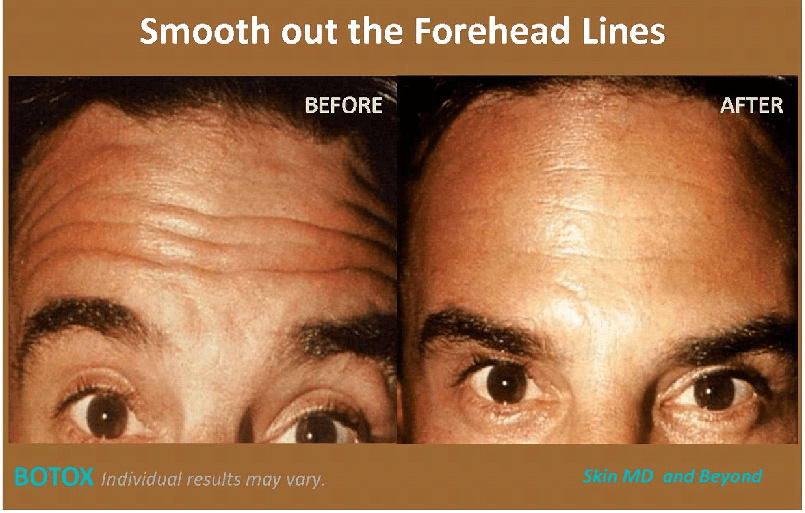 HORIZONTAL FOREHEAD LINES