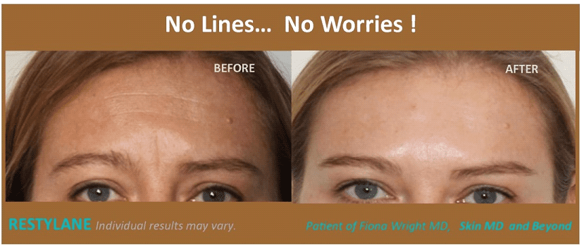 HORIZONTAL FOREHEAD LINES