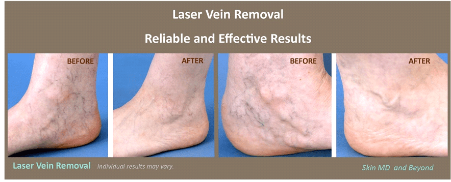Laser Hair Removal 10