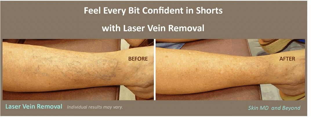 Laser Hair Removal 11