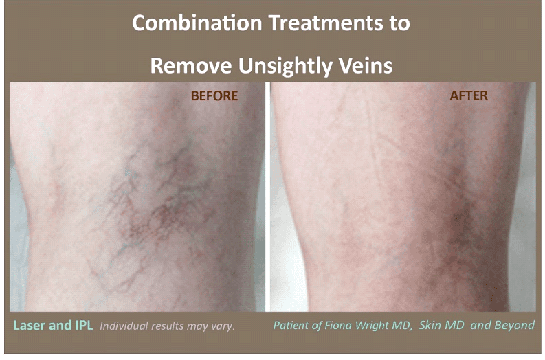 Spider Veins  DOC Vein Management