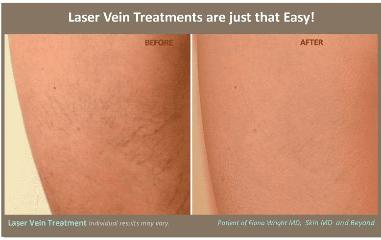 Spider Vein Treatment Plano, TX