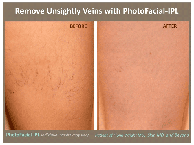 Spider Vein Treatment Plano, TX