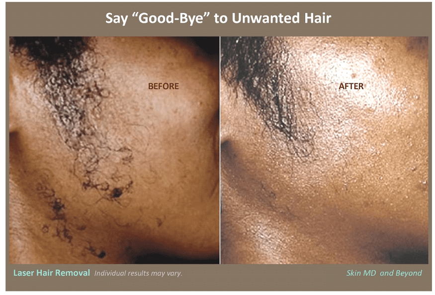 Laser hair on sale removal dallas