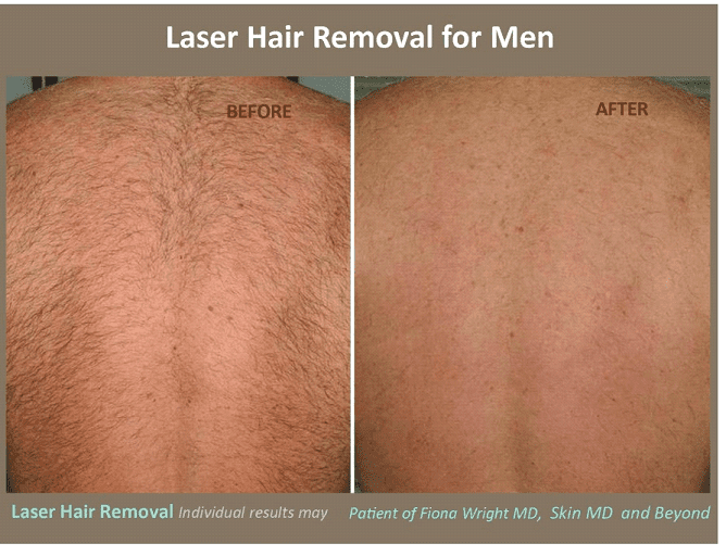 Laser Hair Removal 3