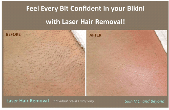 Laser Hair Removal 4